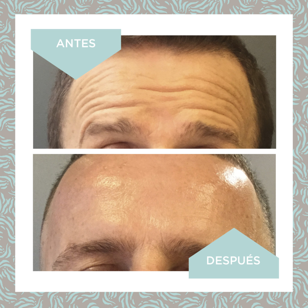 botox 2