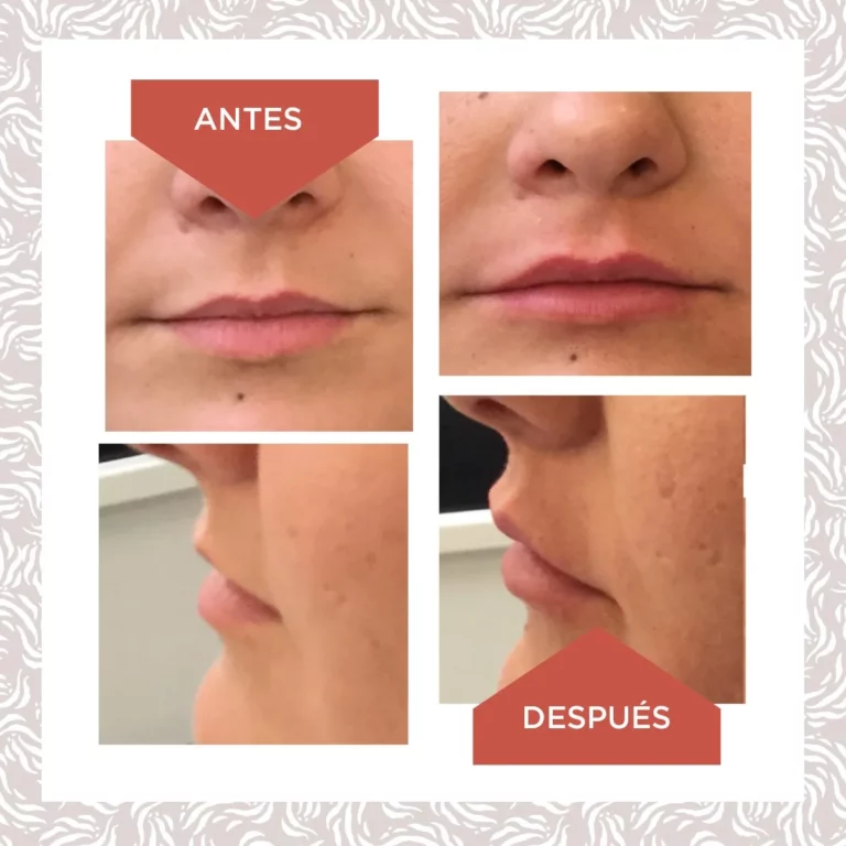 Plantilla Antes Despues 2