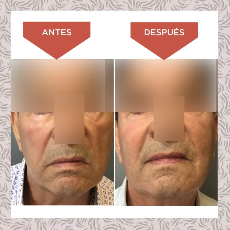 Reposicion Volumen Prueba Ok