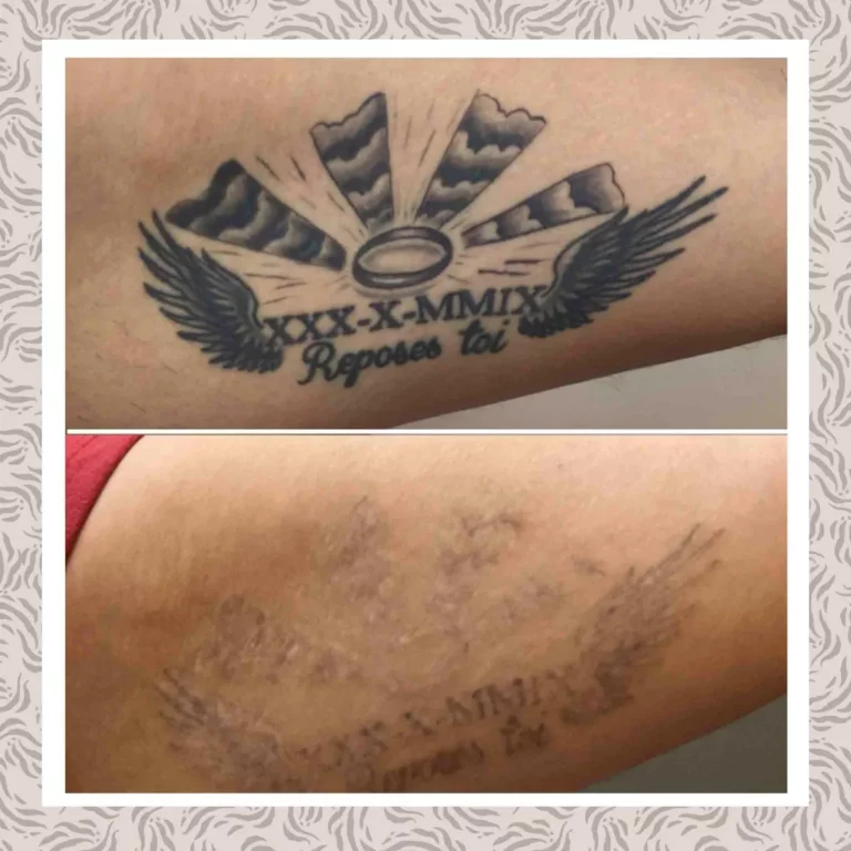 Eliminacióntatuajes