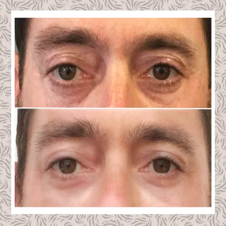 Ojeras Maspalomaspsd