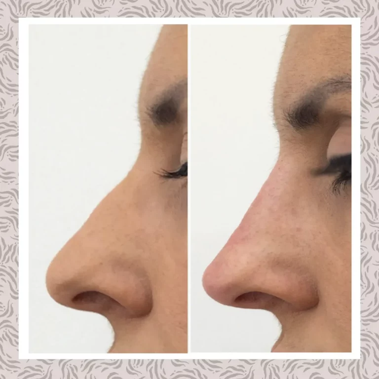 Rinoplastia Antesy Después