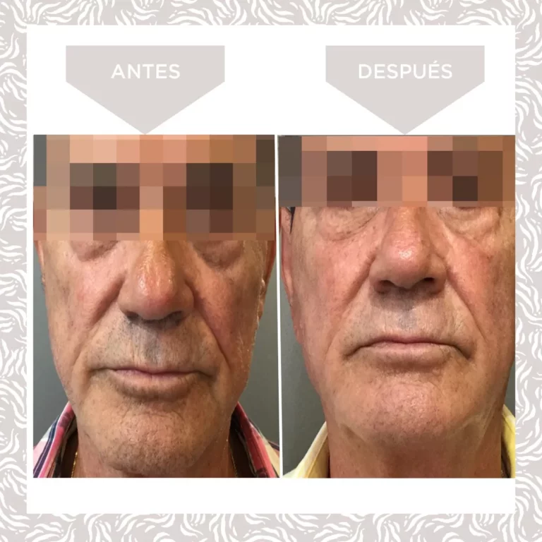 Volumen Facial Definitiva