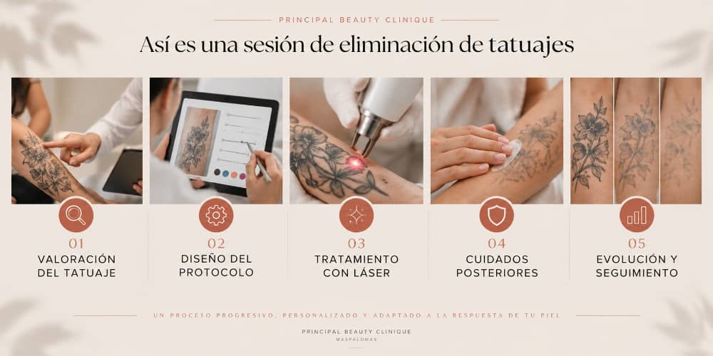 Sesion De Eliminacion De Tatuajes En Principal Beauty Clinique (1)