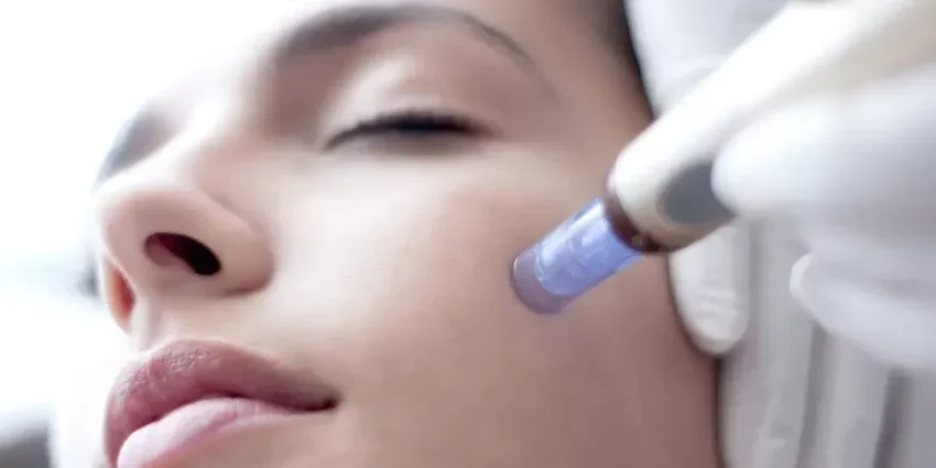 Microneedling EstÉtico